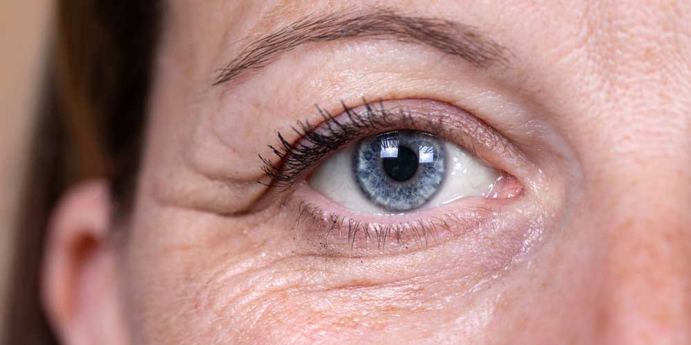 پرکننده اسید هیالورونیک، برای اصلاح حفره زیر چشمی