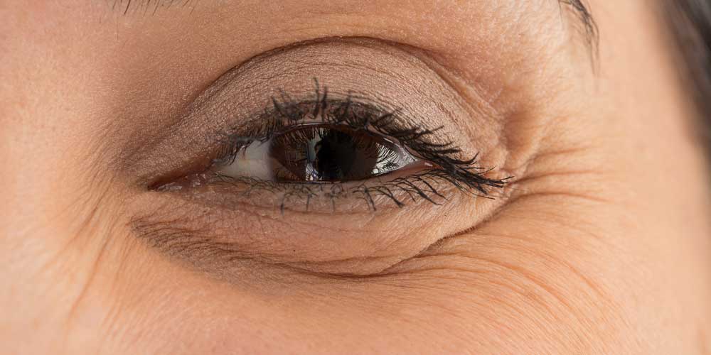 پرکننده اسید هیالورونیک، برای اصلاح حفره زیر چشمی